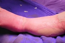 Khi trẻ bị bỏng, các bậc phụ huynh không nên tự ý điều trị cho con bằng các loại thuốc lá, các loại cây không rõ nguồn gốc (Ảnh minh họa) 