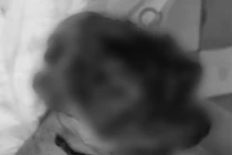 Anh H. bị mất bàn tay phải vì bình ga mini phát nổ (Ảnh: BVCC) 