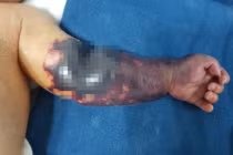 Hình ảnh cánh tay bé T. khi mới vào viện (Ảnh - BVCC) 