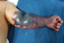 Hình ảnh cánh tay bé T. khi mới vào viện (Ảnh - BVCC) 