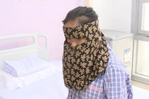 Cô gái có khối u khủng trên mặt (Ảnh - BVCC) 