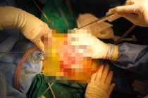 Các bác sĩ phẫu thuật ổ bụng cho bé gái bị thủng bụng, lộ toàn bộ ruột non (Ảnh - BVCC) 