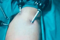 Các bác sĩ phẫu thuật nội soi cho bệnh nhi (Ảnh - BVCC)