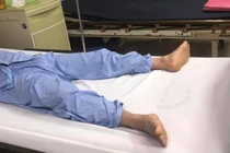 Bệnh nhân tự bẻ cong dương vật đã bình phục sau mổ (Ảnh: BVCC) 