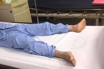 Bệnh nhân tự bẻ cong dương vật đã bình phục sau mổ (Ảnh: BVCC) 