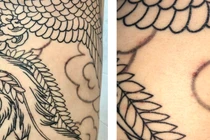 Nam thanh niên bị nhiễm trùng da sau xăm hình (Ảnh: BVCC) 