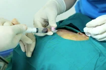 Các bác sĩ tiến hành phẫu thuật cho bệnh nhân. Ảnh: Bệnh viện E. 