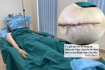 Bệnh nhân bị biến chứng nặng nề sau hút mỡ bụng (Ảnh: BSCC) 