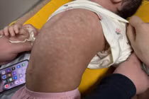 Nhiều trẻ mắc bệnh sởi những ngày đầu năm