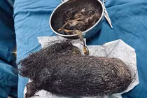 Bóc búi tóc khổng lồ nặng 900 gram được lấy từ trong dạ dày bé gái 12 tuổi ở Quảng Ngãi. Ảnh BVCC.