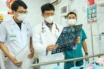 PGS.TS. Mai Duy Tôn - Giám đốc Trung tâm Đột quỵ, Bệnh viện Bạch Mai (đứng giữa) đang thăm khám cho bệnh nhân