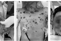 Nạn nhân bị đa chấn thương sau vụ nổ laptop (Ảnh BVCC)