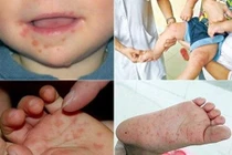 Sốt xuất huyết và tay chân miệng vẫn tiếp tục hoành hành với số bệnh nhân tăng cao