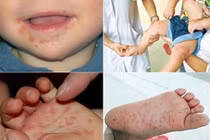 Sốt xuất huyết và tay chân miệng vẫn tiếp tục hoành hành với số bệnh nhân tăng cao