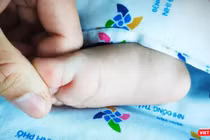 Tay chân miệng có thể gây nhiều biến chứng nguy hiểm ở trẻ. Ảnh: Bệnh viện Nhi Đồng TP.HCM