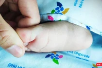 Tay chân miệng có thể gây nhiều biến chứng nguy hiểm ở trẻ. Ảnh: Bệnh viện Nhi Đồng TP.HCM