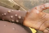 Bệnh đậu mùa khỉ đang lây lan nhanh tại nhiều quốc gia 