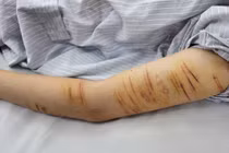 Người trẻ rủ nhau tự gây thương tích, bác sĩ chỉ ra nguyên nhân kèm lời khuyên