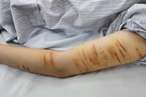 Người trẻ rủ nhau tự gây thương tích, bác sĩ chỉ ra nguyên nhân kèm lời khuyên