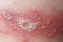  Cô đơn, căng thẳng làm tăng nguy cơ mắc zona thần kinh