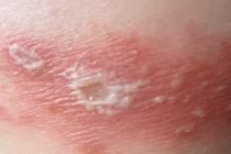  Cô đơn, căng thẳng làm tăng nguy cơ mắc zona thần kinh