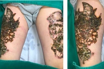 Xóa xăm ở cơ sở không an toàn dẫn đến nhiễm trùng nặng (ảnh: Lê Vinh)