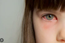 Hôm nay, Sở Y tế TP HCM công bố đã xác định được tác nhân gây bệnh đau mắt đỏ trên địa bàn