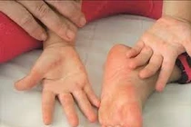 Đã có 3 ca tử vong do bệnh tay -chân -miệng trong năm 2023