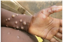 Triệu chứng biểu hiện của bệnh đầu mùa khỉ