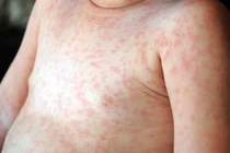 Bộ Y tế yêu cầu TP.HCM khẩn trương tăng cường giải pháp ứng phó với dịch sởi