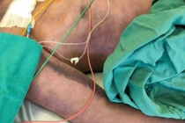 Người đàn ông rơi vào nguy kịch sau khi ăn lòng lợn