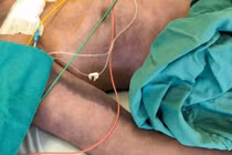 Người đàn ông rơi vào nguy kịch sau khi ăn lòng lợn