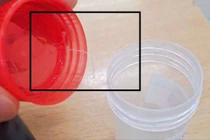 Hiếm gặp: Ký sinh trùng nghi là giun rồng dài 10 cm trong mắt người phụ nữ 