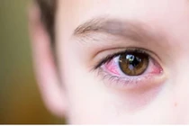 Dịch đau mắt đỏ đang bùng phát 