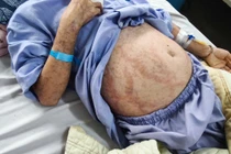 Tự mua thuốc uống, cô gái bị hoại tử da, nhiễm trùng toàn thân