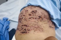 Zona thần kinh ở người cao tuổi dễ bị biến chứng nặng 