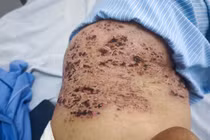 Zona thần kinh ở người cao tuổi dễ bị biến chứng nặng 