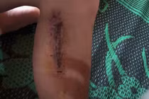 Vì sao chuyên gia dự báo sẽ có thêm người mắc giun rồng ở Việt Nam?