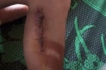 Vì sao chuyên gia dự báo sẽ có thêm người mắc giun rồng ở Việt Nam?