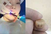 Một khách hàng trẻ đang làm thủ thuật "xăm răng" với hai chữ "Bạo phú" (Giàu nhanh). Ảnh: Orientaldaily.