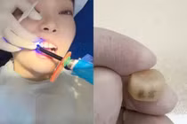 Một khách hàng trẻ đang làm thủ thuật "xăm răng" với hai chữ "Bạo phú" (Giàu nhanh). Ảnh: Orientaldaily.