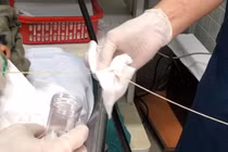 Một phần con sán dây bò được lấy ra khỏi tá tràng của bệnh nhân. Ảnh: BVCC