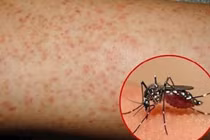 Muỗi vằn, tác nhân lây truyền bệnh sốt xuất huyết