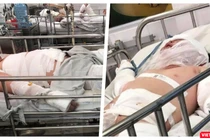 Thương tâm hai bệnh nhi bỏng nặng do cha ruột châm lửa đốt nhà (Ảnh: MT)