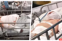 Thương tâm hai bệnh nhi bỏng nặng do cha ruột châm lửa đốt nhà (Ảnh: MT)