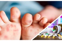 Có thông tin cho rằng thiếu thuốc điều trị bệnh tay chân miệng đang vào mùa cao điểm ở TP.HCM (Ảnh CarePlus, Hòa Bình ghép) 