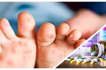 Có thông tin cho rằng thiếu thuốc điều trị bệnh tay chân miệng đang vào mùa cao điểm ở TP.HCM (Ảnh CarePlus, Hòa Bình ghép) 