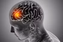 Các nhà khoa học cho thấy một khả năng mới điều trị u nguyên bào thần kinh đệm. Ảnh Euro News. Next