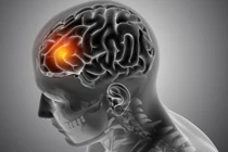 Các nhà khoa học cho thấy một khả năng mới điều trị u nguyên bào thần kinh đệm. Ảnh Euro News. Next