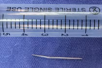 Chiếc xương cá dài 2,5cm được lấy từ sàn miệng bệnh nhân